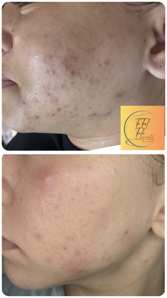 אקנה הורמונלי